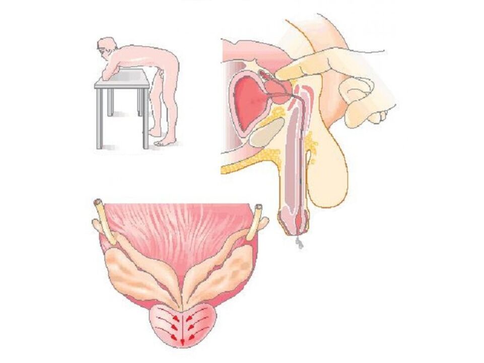 Prostate massage technique by a doctor to analyze secretion